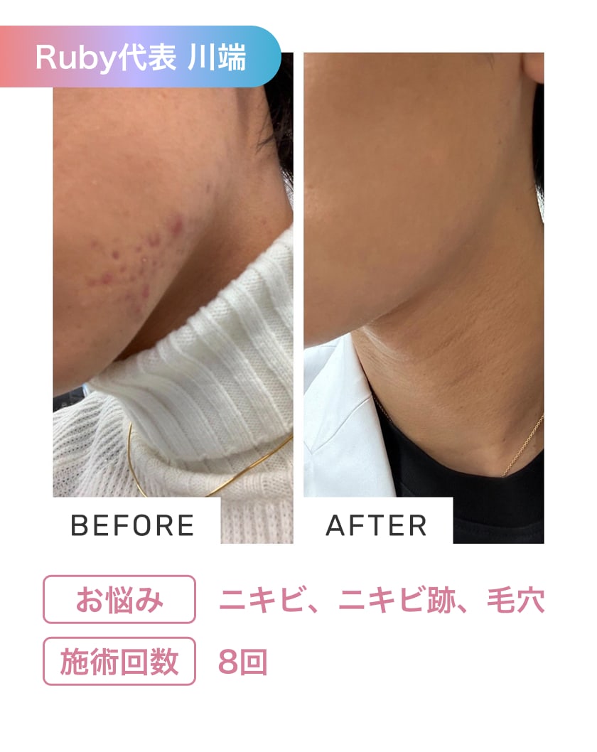 Rubyのハーブピーリングの施術実績1