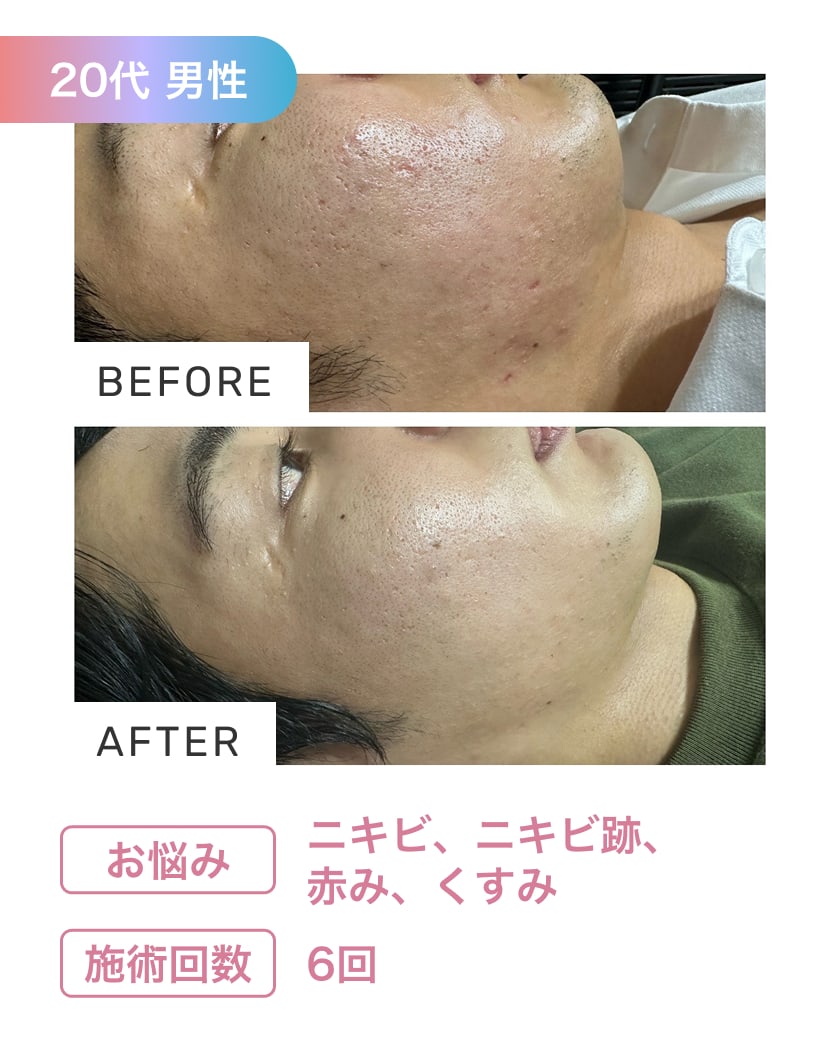 Rubyのハーブピーリングの施術実績3